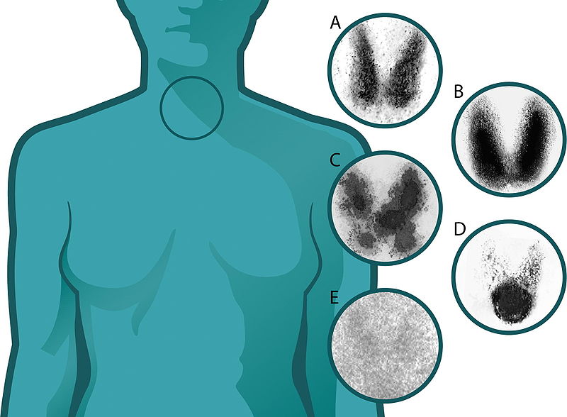 Thyroid scintigraphy